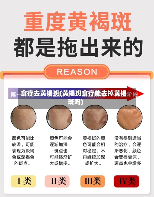 食疗去黄褐斑(黄褐斑食疗能去掉黄褐斑吗)-第1张图片